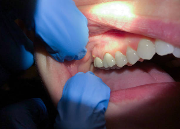 Best Emergency Wisdom Tooth Extraction in Butler, AL